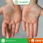 Trẻ bị chân tay miệng tắm lá gì nhanh khỏi? Tắm lá liệu có an toàn?