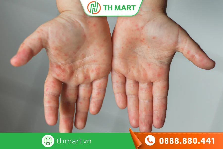 Trẻ bị chân tay miệng tắm lá gì nhanh khỏi? Tắm lá liệu có an toàn?